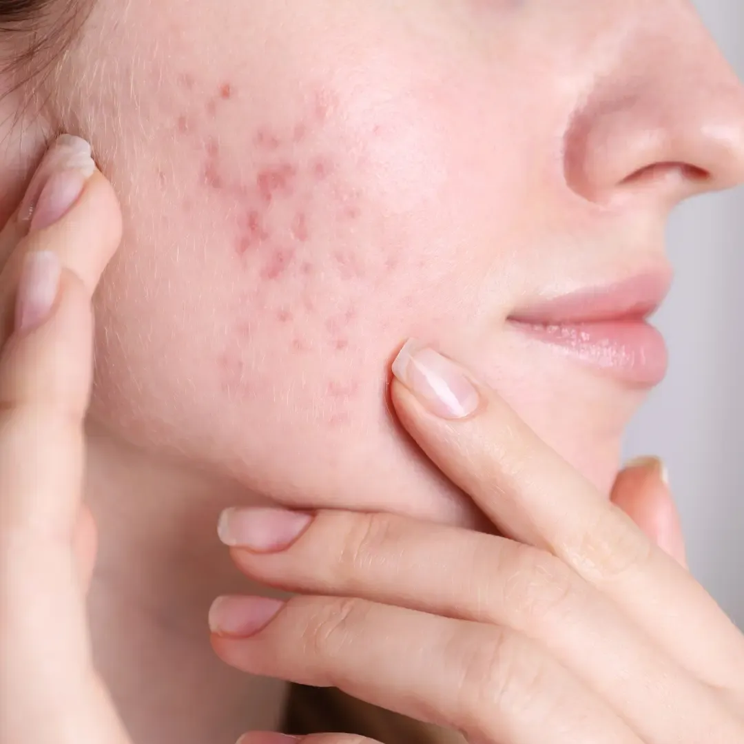 Acne Clear Transformation