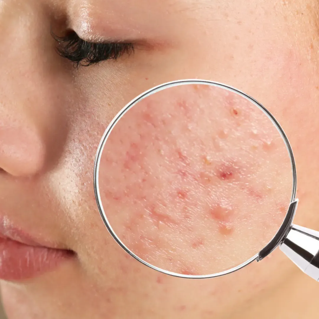 Acne Control Skin Therapy